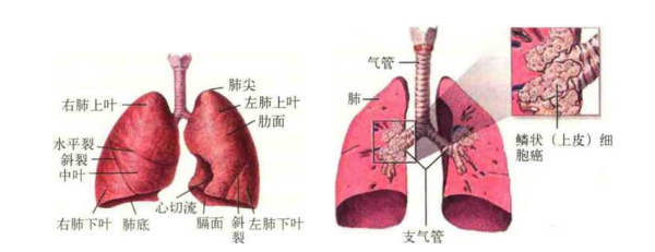 肺癌有哪些分类