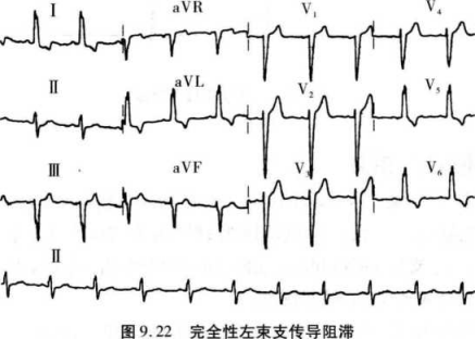 什么是心室内传导阻滞？