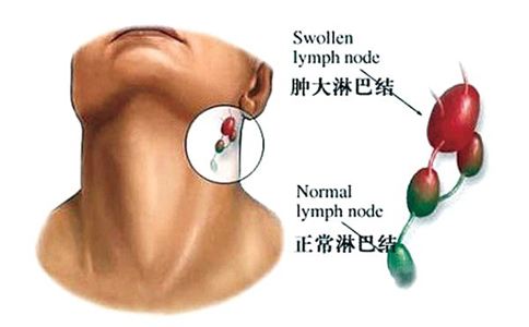 颈部淋巴结肿大常见的原因